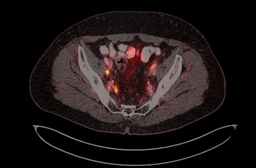 ПЭТ-КТ изображения больного М. с поражением тазовых лимфоузлов