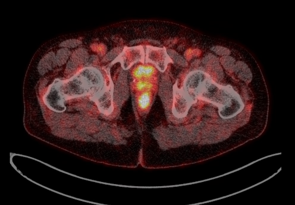 ПЭТ-КТ изображение поражения предстательной железы