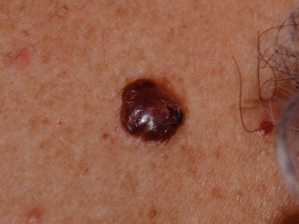 Basal cell carcinoma pigmentnaya
