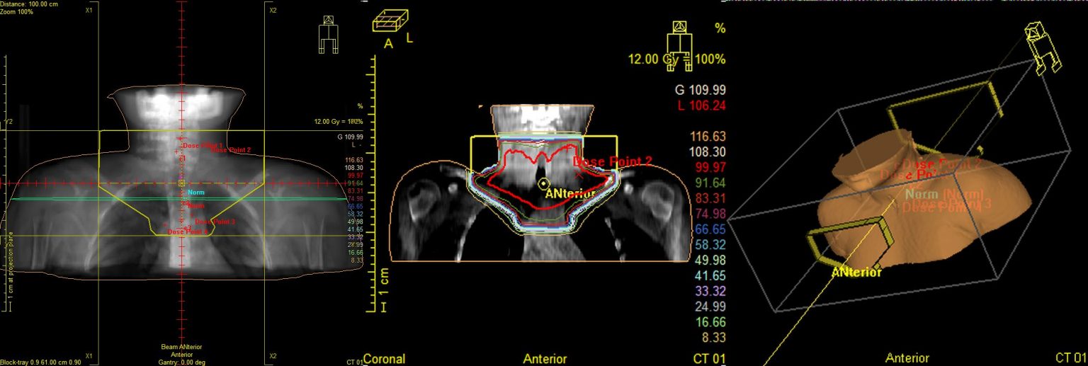 Лимфома Ходжкина у детей: симптомы, лечение, сколько живут