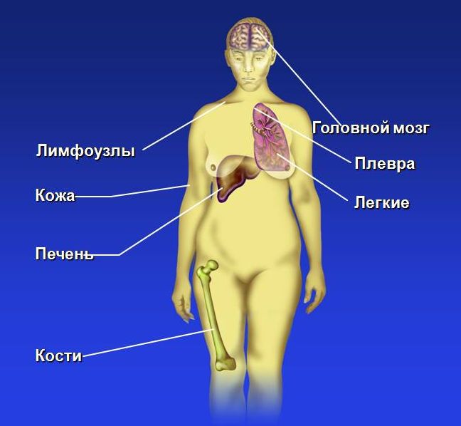 Рак молочной железы (рак груди) - симптомы и лечение