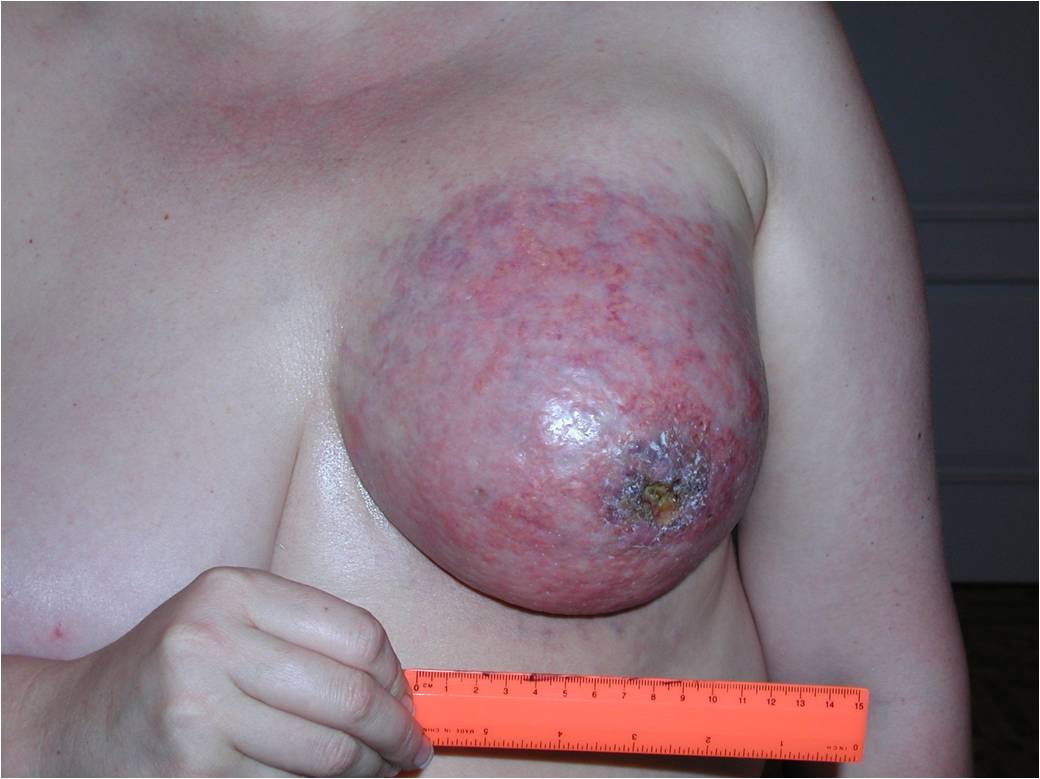 Рак молочной железы: случай своевременной диагностики карциномы