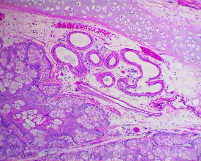 Микропрепарат, тератома яичника