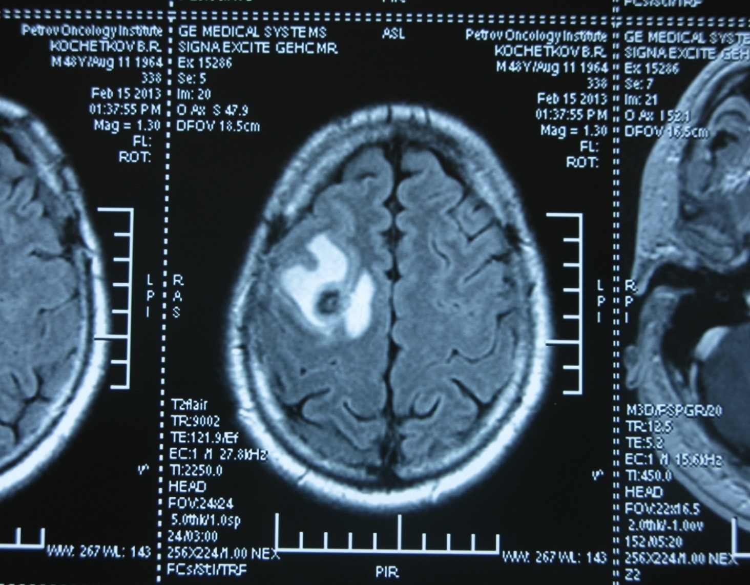 Рак мозга анализы крови. Анализы на опухоль мозга. Мрт головного мозга опухоль. Снимки мрт головы с опухолью.
