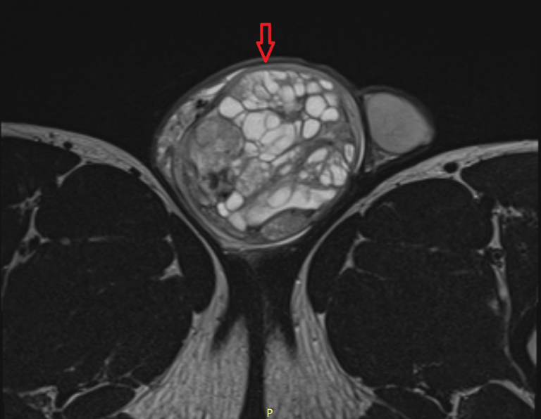 Семинома на узи фото яичка