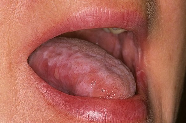 👅 Какие симптомы говорят о возможном развитии рака языка