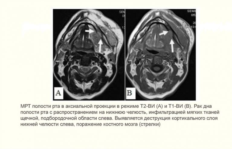 Рак ротовой полости симптомы фото