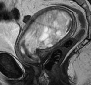 Карциносаркома на МРТ органов малого таза