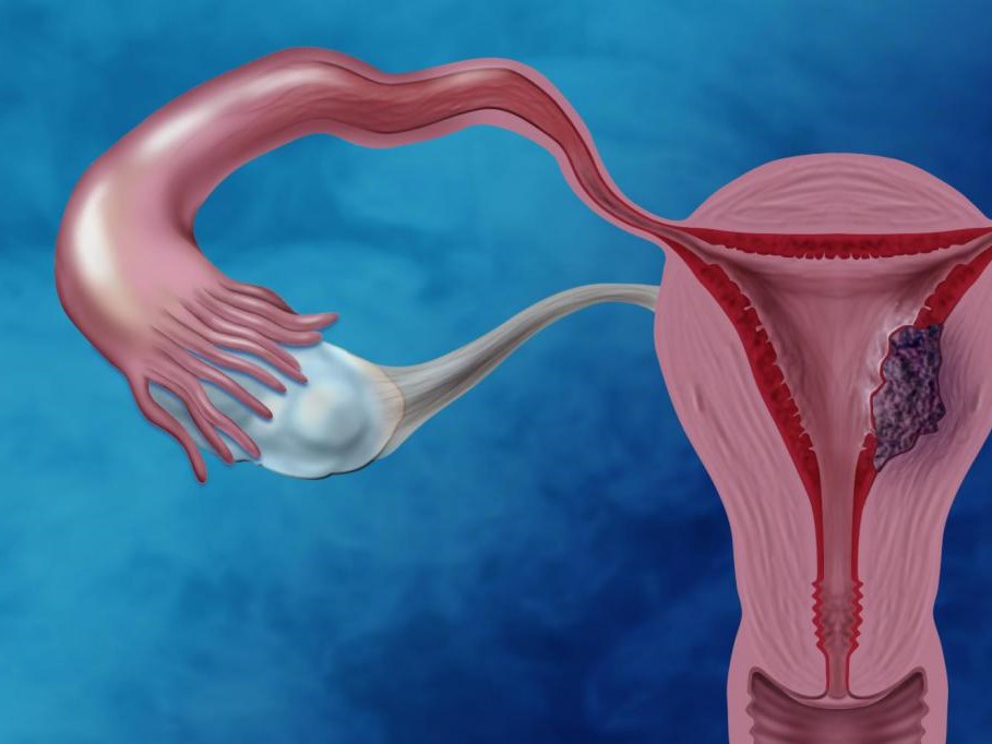 endometrium rák gp