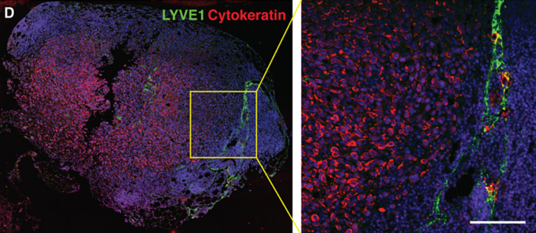 Иммунофлюоресцентная визуализация метастатически пораженного лимфатического узла с окраской на Цитокератин