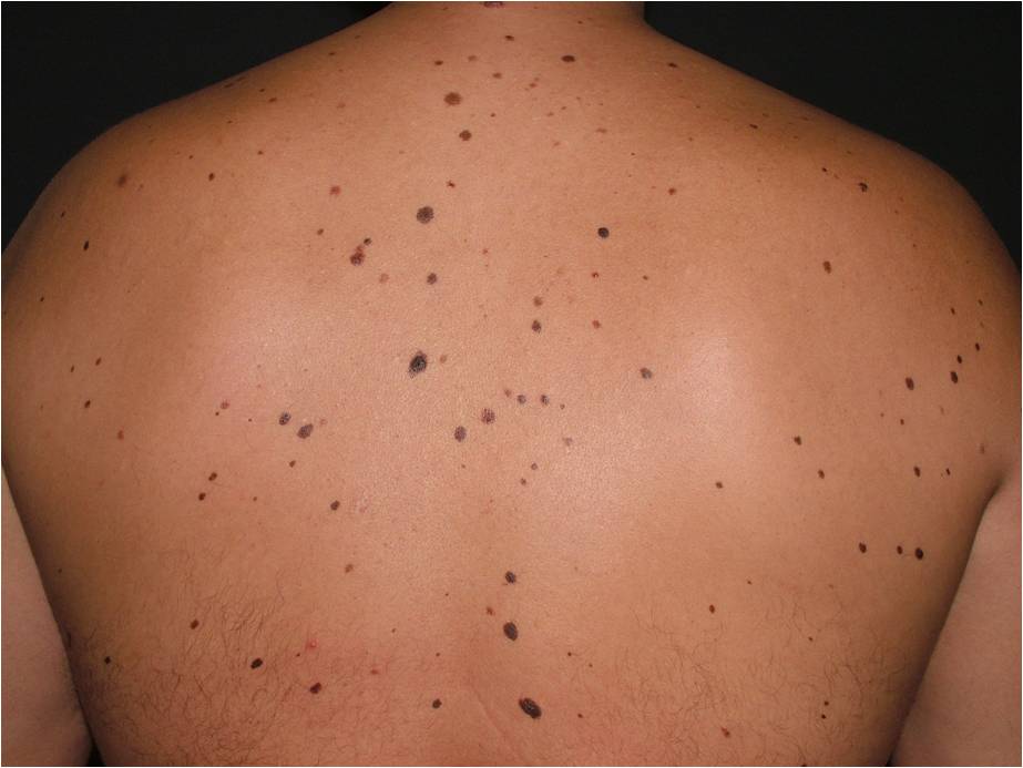 В шаге от онкологии: предраковые заболевания кожи и слизистых оболочек