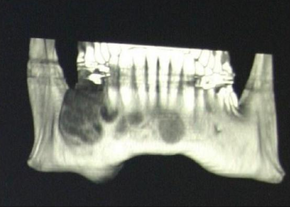 Рис.2: Бурые опухоли нижней челюсти, определяющиеся на рентгенограмме как очаги пониженной плотности в толще кости