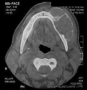 Рис. 5: КТ – признаки бурой опухоли верхней челюсти: гиподенсный литический очаг с расслоением надкостницы 