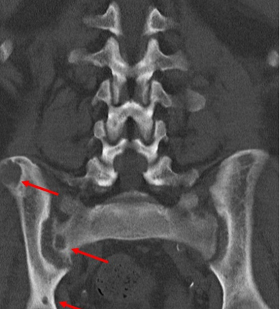 Рис. 6: Магнитно-резонансная томография (МРТ) – множественные гиподенсные очаги костей таза, имеющие кистозный характер
