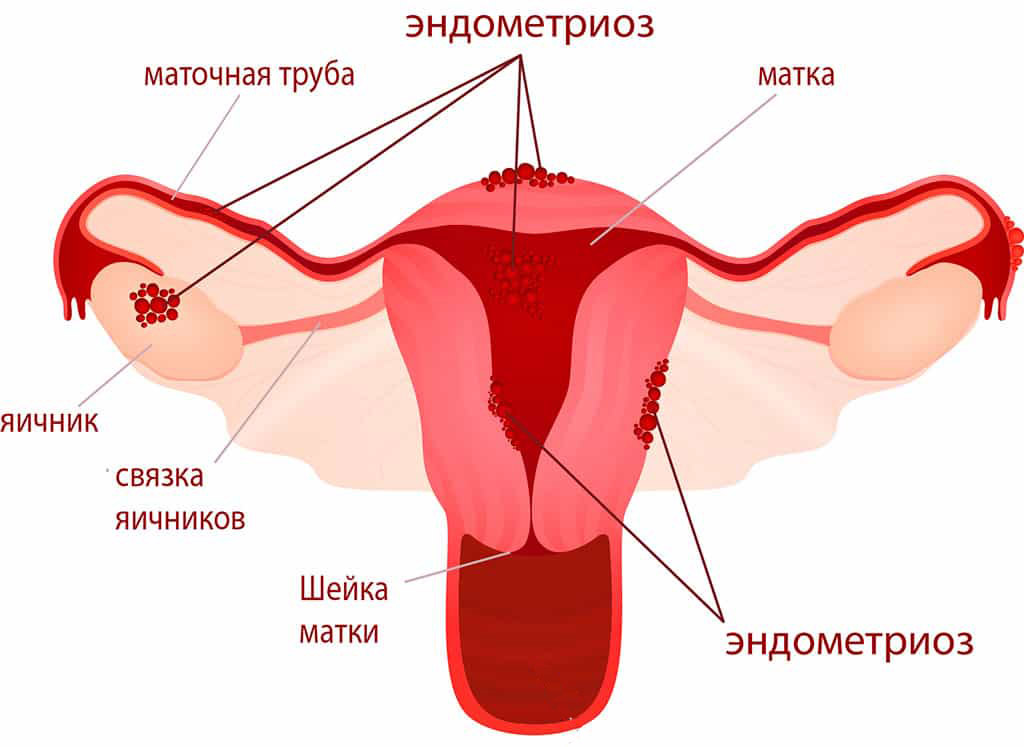Cuanto tiempo tarda en desarrollarse un cáncer de endometrio