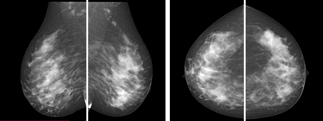 Рис.1 Маммография, выполненная в двух проекциях: фиброаденома левой молочной железы