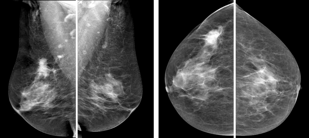 Рис.2 Маммография, выполненная в двух проекциях: рак правой молочной железы