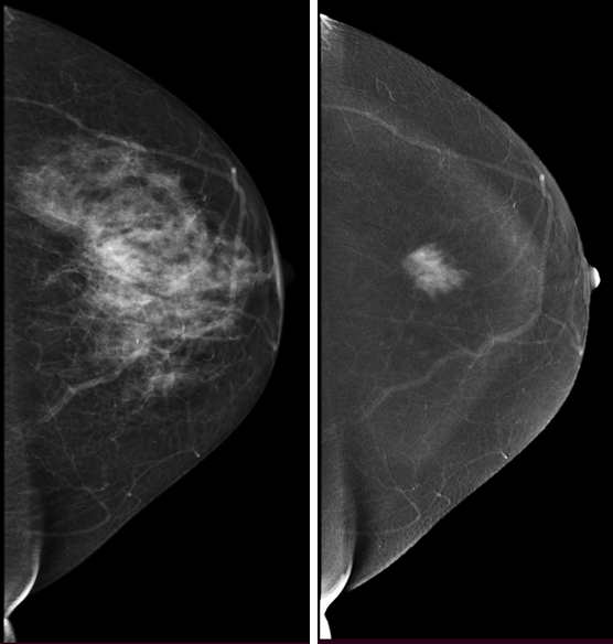 Рис.5 Маммограмма с контрастом: рак молочной железы
