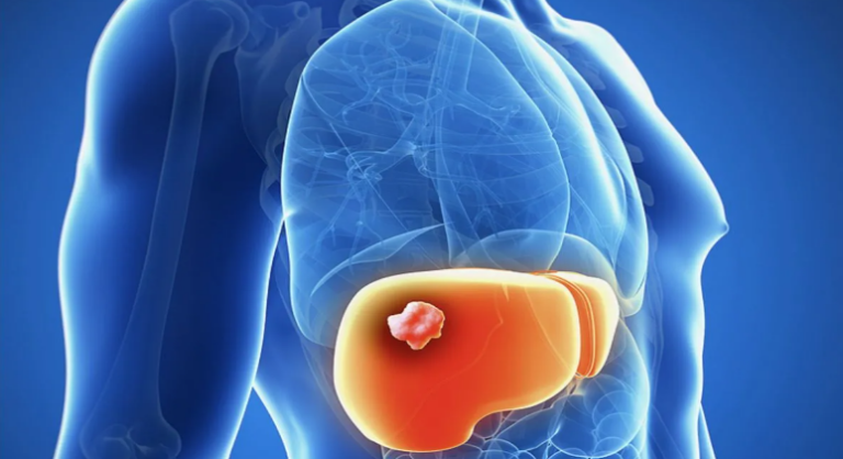 Рак печени: диагностика, лечение, профилактика